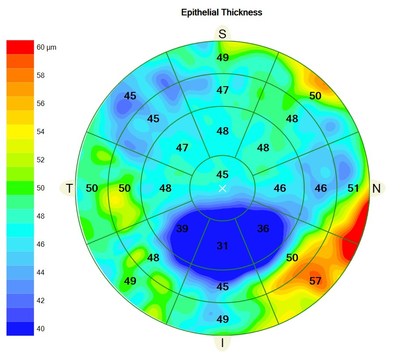 ZEISS CIRRUS Epithelial Thickness Mapping