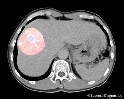 Pseudocolor accentuated CT scan image of a liver tumor.