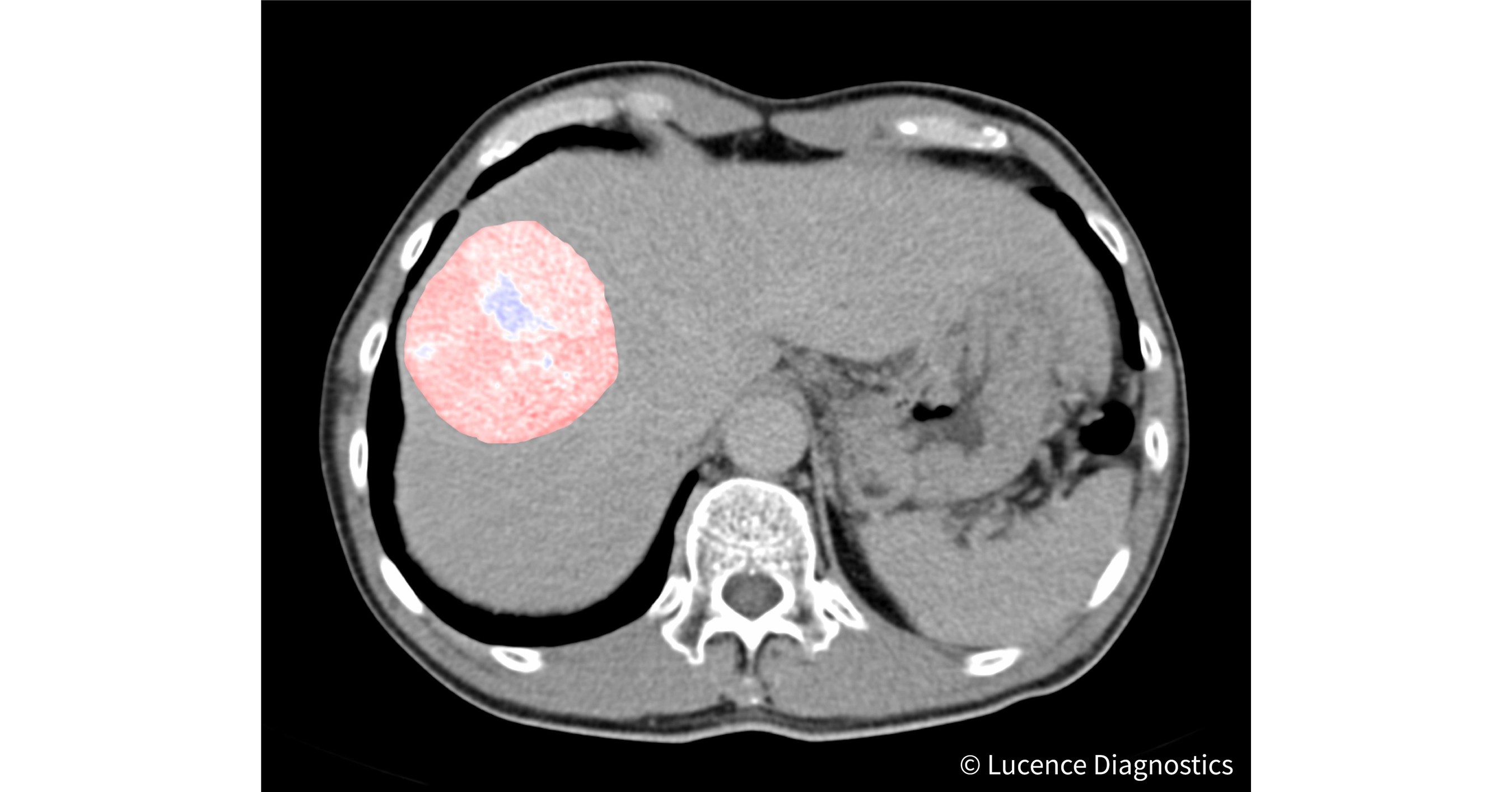 Lucence Diagnostics to Develop AI Tools for Liver Cancer Treatment