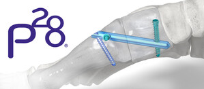 Small Bone Phantom 3-Hole Intramedullary Nail Added to Already Robust Offering for the Lapidus Arthrodesis Procedure