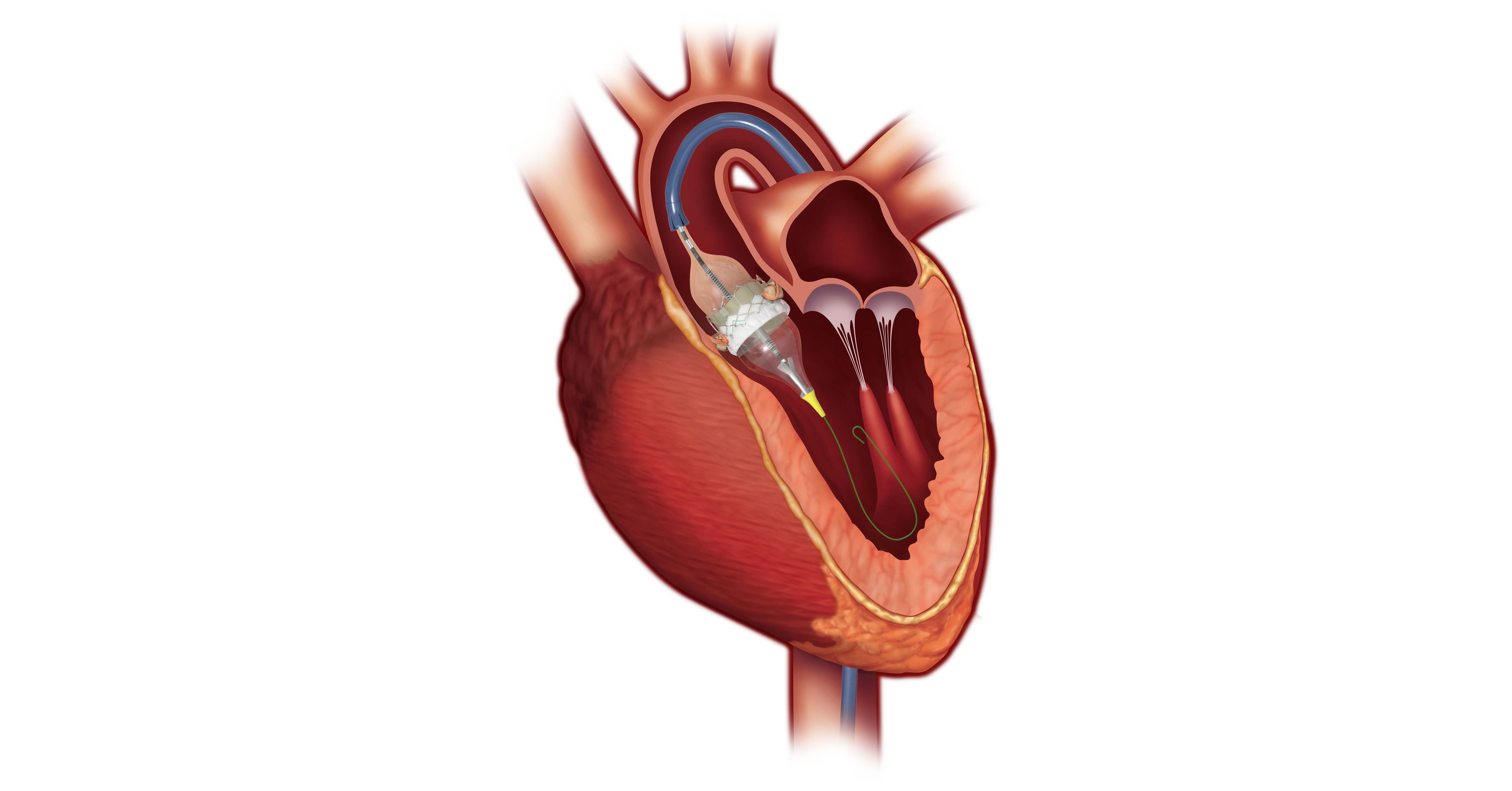 Edwards SAPIEN 3 Valve Proves Superior To Surgery In Partner 3 Trial