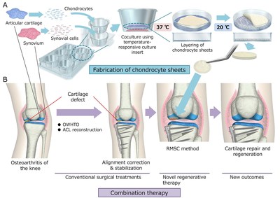 Chondrocyte cell-sheet preparation (A) and combined surgery/transplantation approach for osteoarthritis of the knee (B).