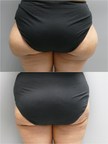 Combination Liposuction Modalities Yield Superior Body Sculpting Capabilities And Increased Patient Satisfaction