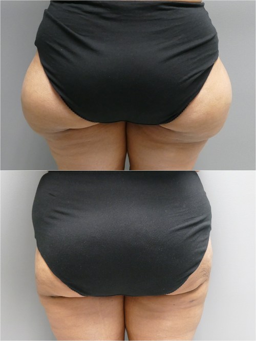 50 year old female with abnormal fat deposits, commonly known as saddle bags, underwent combination liposuction procedure using ultrasonic skin tightening liposuction and power liposuction for permanent correction. Post op photo taken 3 weeks post procedure.