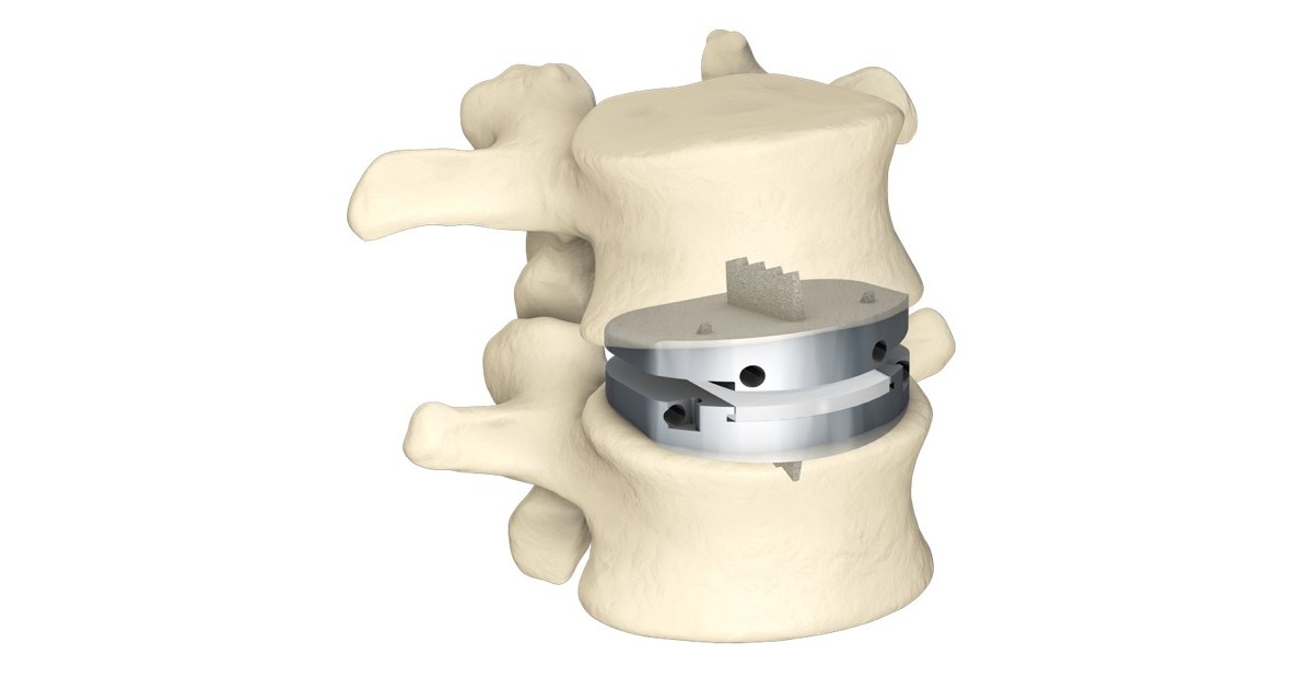 Updated NASS Position on Lumbar Artificial Disc Replacement Matches ...