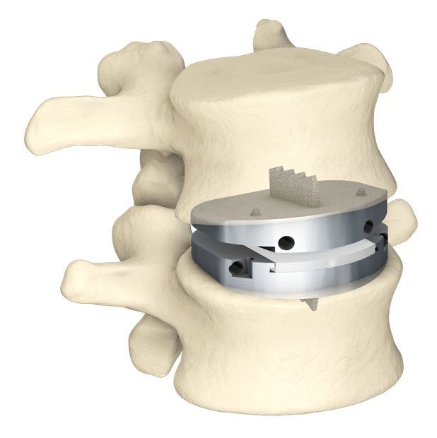 Updated NASS Position on Lumbar Artificial Disc Replacement Matches Centinel Spine's prodisc® L