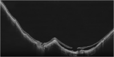 Ultra HD Spotlight of a Myopic Staphyloma with a 6mm B-scan depth acquired at 200kHz enabling clinicians to fully image and assess highly curved retina. Courtesy of Professor Jean-Francois Korobelnik.