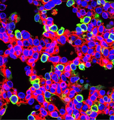 CRISPR-edited lung cells (green) with fluorescent protein. Many, but not all, are alveolar lung cells. Photo credit: Penn Medicine
