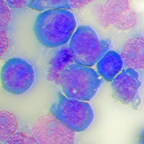 Overlooked Molecular Machine in Cell Nucleus May Hold Key to Treating Aggressive Leukemia