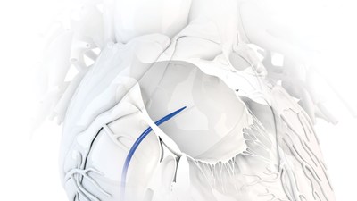 Baylis has launched the ExpanSure™ Transseptal Dilation System in the US, the first-of-its-kind large access transseptal dilator. (CNW Group/Baylis Medical)