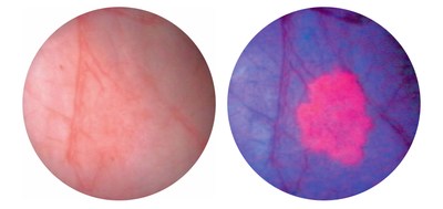 Same bladder image from White Light Cystoscopy and Blue Light Cystoscopy with Cysview®