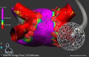 Affera's Technology For Cardiac Arrhythmia Treatment To Be Highlighted In 17 Scientific Sessions At The 2019 Heart Rhythm Society Meeting