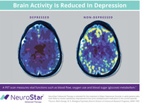 There are differences between a depressed and non-depressed brain, yet a majority of Americans (73 percent) don’t know depression is a brain disorder according to a survey from NeuroStar Advanced Therapy conducted by The Harris Poll.