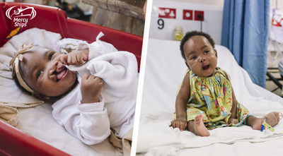 Before and after photos of Aissata's cleft lip surgery.