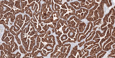 VENTANA ROS1 (SP384) Rabbit Monoclonal Primary Antibody IHC staining of lung adenocarcinoma tissue