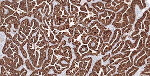 Roche launches first in vitro diagnostic IHC test to detect ROS1 protein in cancers