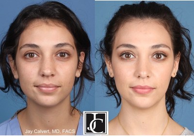 rhinoplasty