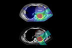 Proton Therapy Shown to Reduce Side Effects for Multiple Cancers