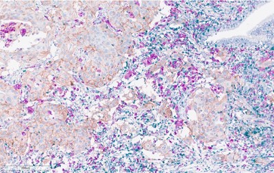 Multiplex stain for CD3 (green), PD-L1 (brown), CD68 (pink) on non-small cell lung carcinoma (NSCLC) patient sample 