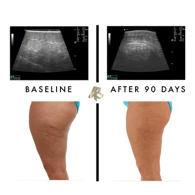 This image shows an ultrasound of the side of the thigh from the surface, at the top, to the femur bone at the bottom. In the Baseline image the fascia is disorganized, thickened and has adhesions. In the 90 days of FasciaBlasting® image, the tissue is smooth, hydrated and the collagen fibers are reorganized.