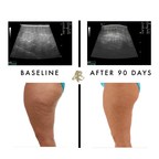 New Study Shows Cellulite Restored And Underlying Fibrotic Tissue Remodeled: Providing Hope For A Host Of Medical Issues