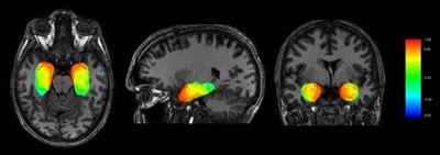 Figure 1: Heat map of the likelihood of relevance of ablation for seizure control, generated from 234 patients from 11 comprehensive epilepsy centers. Colored zones were ablated; red zones show higher likelihood of ablation contributing to seizure control. Image courtesy of Pierre-Francois D’Haese, Neurotargeting, LLC.