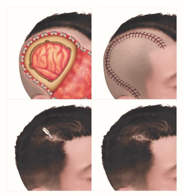 Figure 2: Top row: Open craniotomy - intraoperative and postoperative. Bottom row: Minimally invasive laser ablation - intraoperative and postoperative.