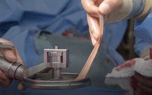 Exsurco Medical Announces Recently Published Peer Reviewed White Paper on the Innovative Amalgatome SD Skin Grafting and Wound Debridement Device