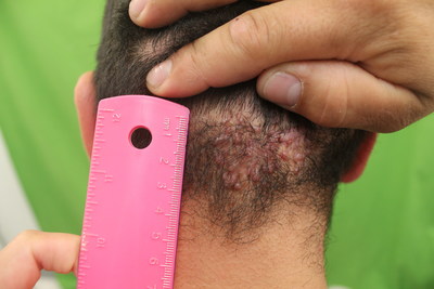 bald head razor bump treatment