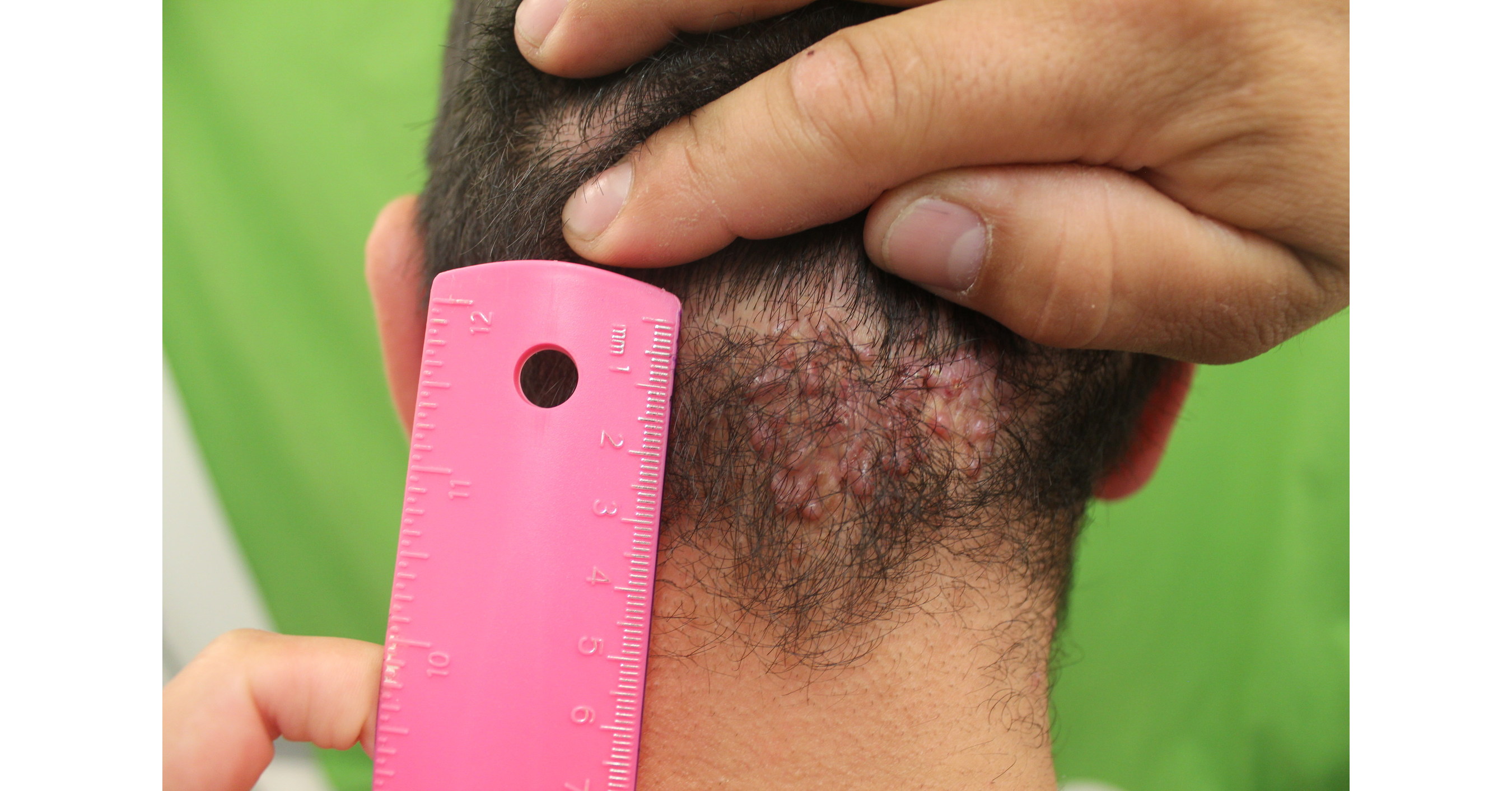 Groundbreaking Discoveries For Treatment Of Back Of Head Razor Bumps