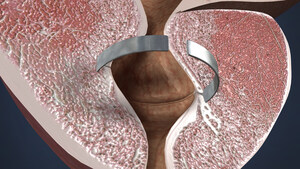 ProArc Medical Awarded $2.2 Million European Union Grant