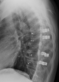 Lateral x-ray image of a patient stabilized with icotec VADER&reg; pedicle screw system (courtesy of Prof. B. Meyer, TU Munich, Germany)