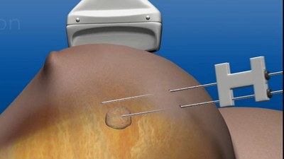 Novilase Breast Therapy uses laser induced heat for focal destruction of breast tumors up to 2 cm.