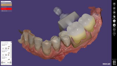 ChairsideCAD is the first complete open-architecture CAD software platform for same-day dentistry. The chairside workflow is streamlined, easy to learn, and optimized for use in the practice, including a step-by-step guide through the design process. It is based on the same proven technology as exocad’s "best-of-breed“ lab software, renowned for its reliability and robust features. In just a few steps, exocad‘s ChairsideCAD creates highly esthetic proposals with minimal post processing. ChairsideCAD is the first complete open-architecture CAD software platform for same-day dentistry. The chairside workflow is streamlined, easy to learn, and optimized for use in the practice, including a step-by-step guide through the design process. It is based on the same proven technology as exocad’s "best-of-breed“ lab software, renowned for its reliability and robust features. In just a few steps, exocad‘s ChairsideCAD creates highly esthetic proposals with minimal post processing.