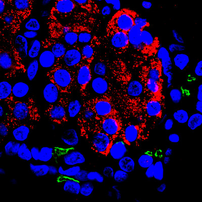 This microscopic image shows human pancreatic tissue color coded to show the presence of insulin and the gene CFTR (cystic fibrosis transmembrane conductance regulator). Researchers report in Nature Communications they used bioengineered human pancreatic tissue on a chip to determine that in addition to causing cystic fibrosis, disruption in CFTR gene expression also may help drive the dangerous complication Cystic Fibrosis-Related Diabetes.