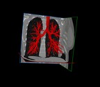 RSIP Vision's Advanced AI Technology Provides Segmentation with Unmatched Precision for Interventional Lung Procedures