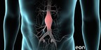 Market Leader for Patient Identification and Tracking Software, EonDirect, Expands to Abdominal Aortic Aneurysm