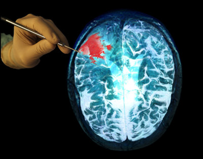 Real-time Raman spectroscopy offers new hope to brain cancer patients, by giving surgeons a transformative technology that can differentiate healthy tissue from cancer-invaded tissue with the speed and spatial precision required for these delicate procedures. (CNW Group/ODS Medical) Real-time Raman spectroscopy offers new hope to brain cancer patients, by giving surgeons a transformative technology that can differentiate healthy tissue from cancer-invaded tissue with the speed and spatial precision required for these delicate procedures. (CNW Group/ODS Medical)
