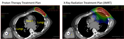 Oklahoma Proton Center Offering Short Course Partial Breast Irradiation Treatment