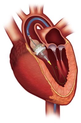 Edwards Lifesciences SAPIEN 3 valve - Anatomic illustration deployed Edwards Lifesciences SAPIEN 3 valve - Anatomic illustration deployed
