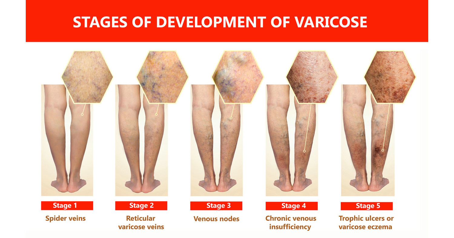 SVS: varicose veins need medical attention?