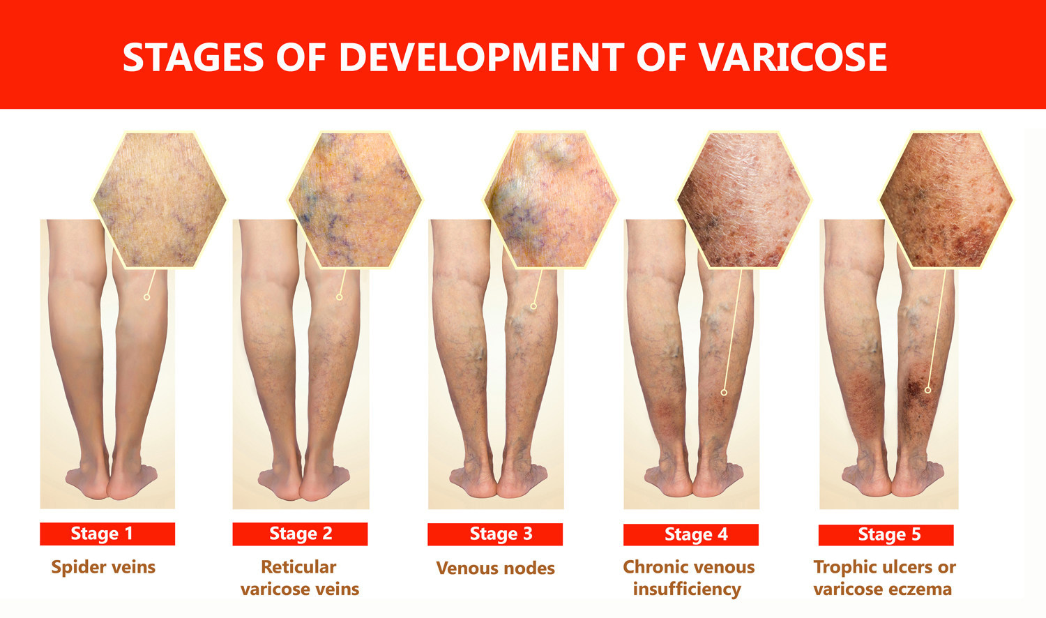 tratamentul serului varicoza varicoza varicoza root