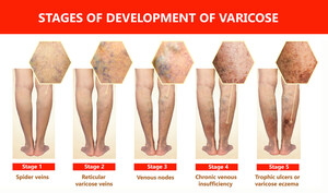 SVS: When do varicose veins need medical attention?