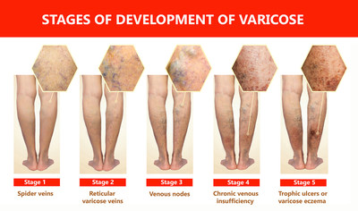 Most people with varicose veins will never have medical problems with them. But for some, the condition develops into something more serious. Most people with varicose veins will never have medical problems with them. But for some, the condition develops into something more serious.