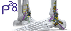 Paragon 28® Adds Comprehensive Ankle Fusion Plating System to its Robust Foot and Ankle Platform - Silverback™ Ankle Fusion Plating System
