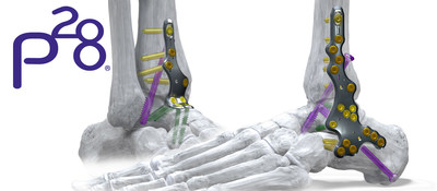 Paragon 28 Silverback Anterior and Lateral Ankle Fusion Plates Paragon 28 Silverback Anterior and Lateral Ankle Fusion Plates