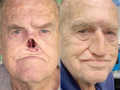 Before and After Reconstruction Before and After Reconstruction