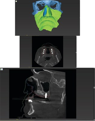 Dr. Joseph Massad DDS presents digital maxillofacial reconstruction with prosthetic using HDX WILL CBCT technology.