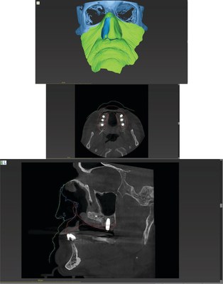 Dr. Joseph Massad DDS presents digital maxillofacial reconstruction with prosthetic using HDX WILL CBCT technology. Dr. Joseph Massad DDS presents digital maxillofacial reconstruction with prosthetic using HDX WILL CBCT technology.