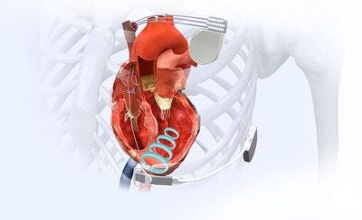 The WiSE Cardiac Resynchronization Therapy (CRT) System.